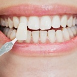 Несъёмные зубные протезы: виниры