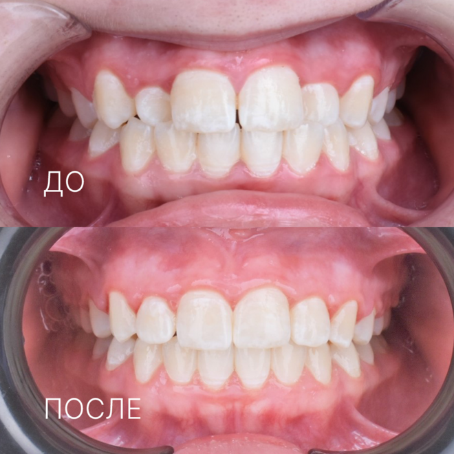 лечение частичной брекет системой в Муроме