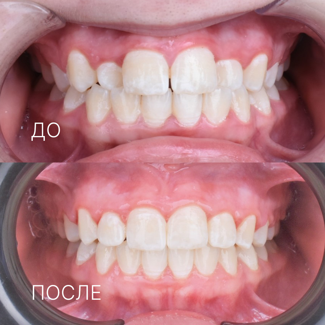 лечение частичной брекет системой в Муроме