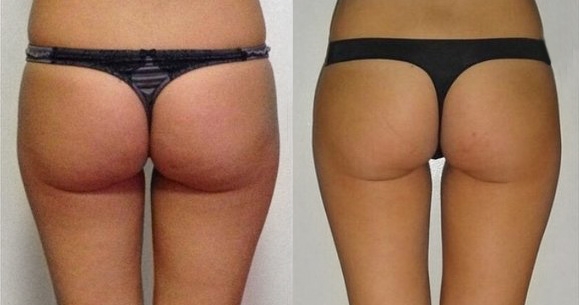 скульптурирование Beautylize