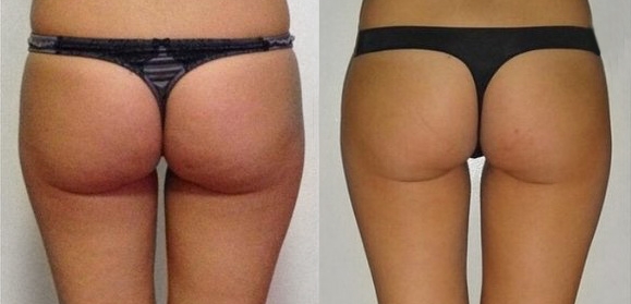 скульптурирование Beautylize