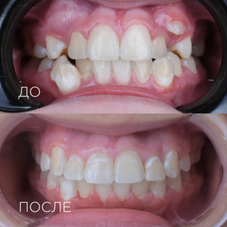 Установка брекет-системы
