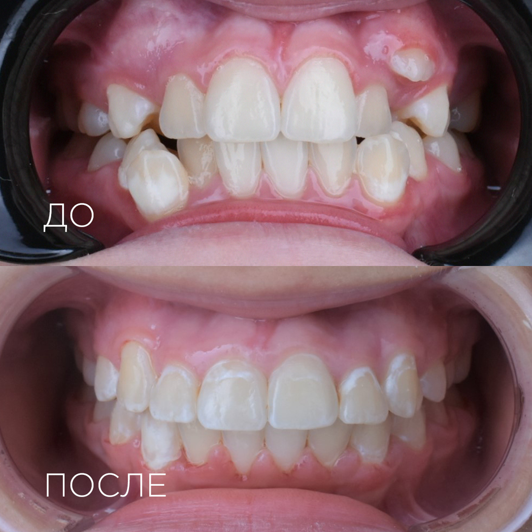 Установка брекет-системы