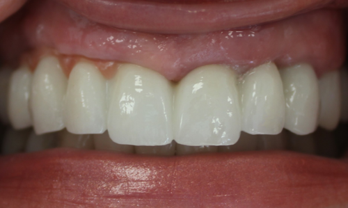 Имплантация на верхней челюсти по хирургичесткому шаблону на 6 имплантах с одномоментным удалением зубов 