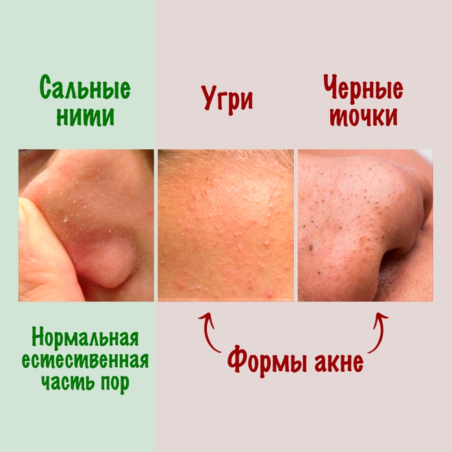 Сальные нити vs Черные точки vs Угри
