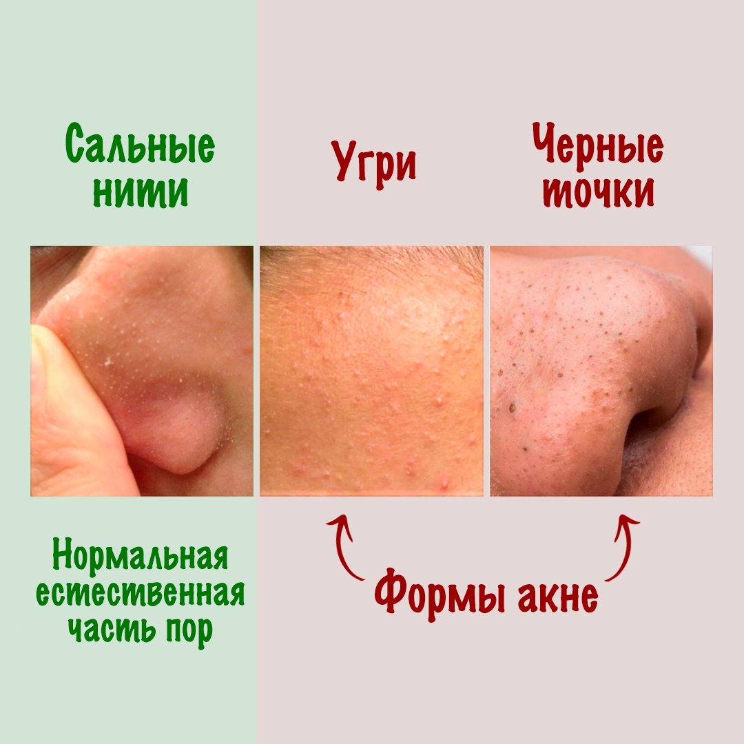 Сальные нити vs Черные точки vs Угри