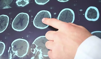 Эпилепсия у взрослых: причины и сиптомы разных видов приступов