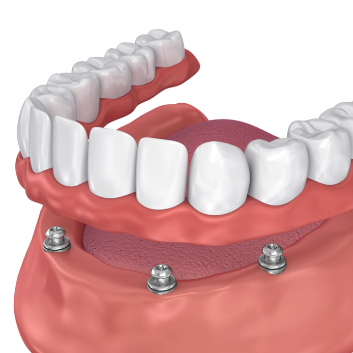 Имплантация зубов all on 6. Миниимпланты съемный протез. Балочный протез на 4 имплантах. Несъёмный зубной протез на 6 имплантах. Несъемный протез на 4 имплантах.