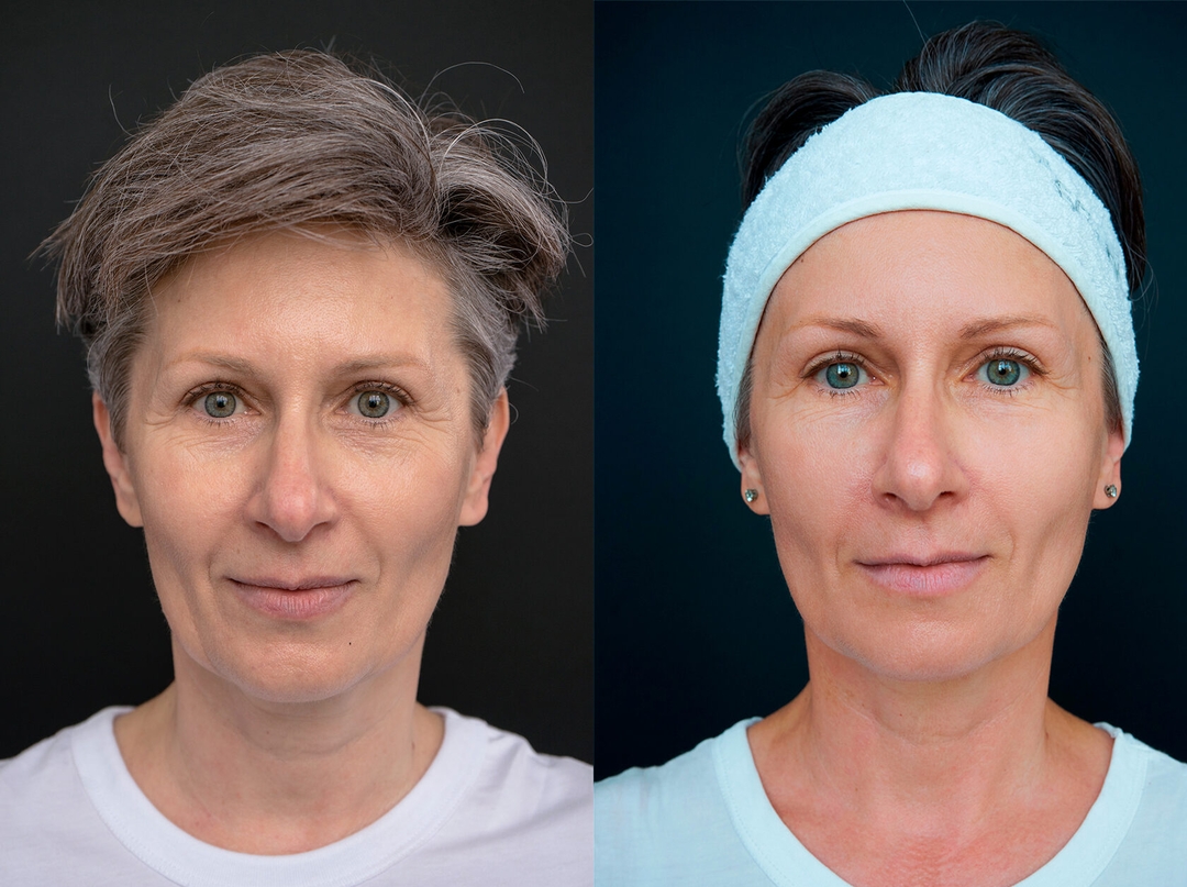 скульптурирование Vivace RF – ЛИФТИНГ Beautylize