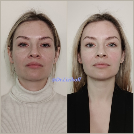 Омоложение лица методикой врача-остеопата Никиты Лизикова
