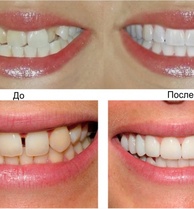 Восстановление и коррекция зубов