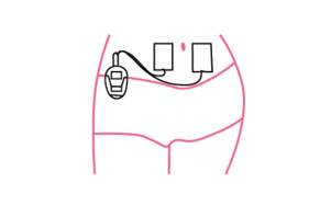 Размещение электростимулятора