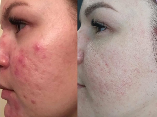 RF – ЛИФТИНГ на аппарате SCARLET S