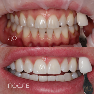 Домашнее отбеливание
