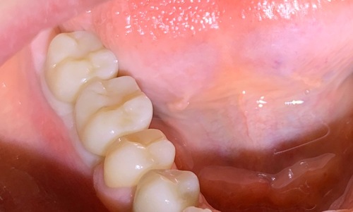 Имплантация двух жевательных зубов в Муроме стоматология Айсберг