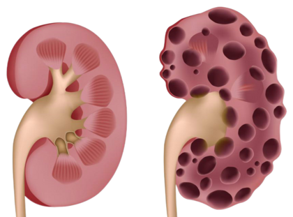 Лечение ХПН у кошек, применение Ипакитине