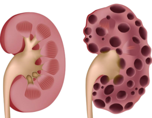 Лечение ХПН у кошек, применение Ипакитине