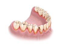 Тяжёлая степень пародонтоза