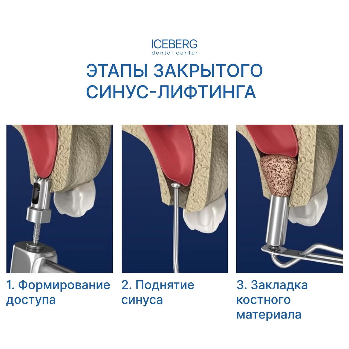 закрытый синус лифтинг